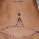 Umbilicoplasty with Mini Tummy Tuck design Dr Barry Eppley Indianapolis