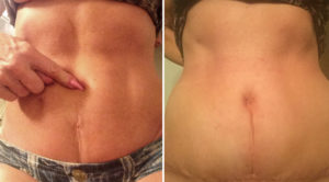 Umbilicoplasty with Mini Tummy Tuck result Dr Barry Eppley Indianapolis