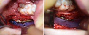 Vertical Lengthening Jaw Angle Implants after Sagittal Split intraop Dr Barry Eppley Indianapolis