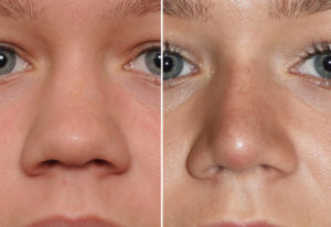 Wide Tip Rhinoplasty result frnt view Dr Barry Eppley Indianapolis