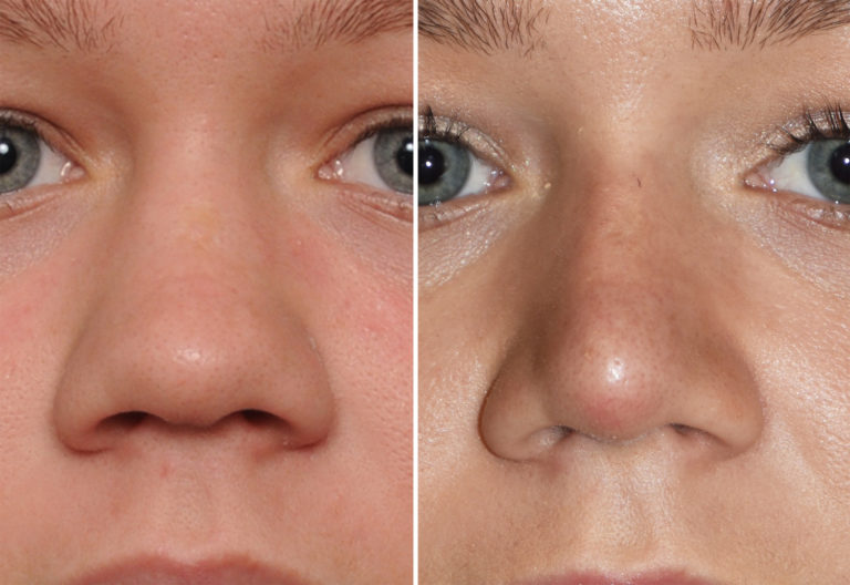 Plastic Surgery Case Study Narrowing in the Wide Nose Rhinoplasty