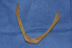 custom-jawline-implant-dr-barry-eppley-indianapolis