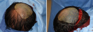 custom-occipital-implant-for-plagiocephaly-intraop-positioning-dr-barry-eppley-indianapolis