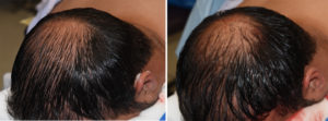 custom-occipital-implant-for-plagiocephaly-intraop-result-oblique-view-dr-barry-eppley-indianapolis