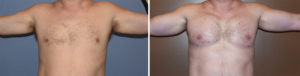 custom-pectoral-and-biceps-implants-result-front-view-dr-barry-eppley-indianapolis