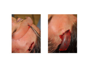 endoscopic-custom-brow-bone-implant-surgical-technique-dr-barry-eppley-indianapolis