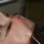 endoscopic-screw-fixation-technique-of-custom-brow-bone-implant-dr-barry-eppley-indianapolis