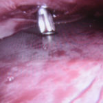 endoscopic-screw-fixation-of-custom-brow-bone-implant-dr-barry-eppley-indianapolis