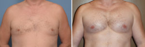 extra-large-pectoral-implants-result-fronty-view-dr-barry-eppley-indianapolis