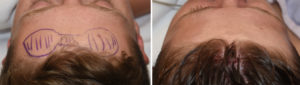 forehead-horn-reduction-surgery-intraop-results-top-view-dr-barry-eppley-indianapolis
