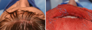 forehead-reduction-incision-dr-barry-eppley-indianapolis