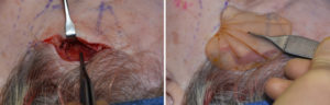 hairline-approach-to-temporal-implants-intraop-2-dr-barry-eppley-indianapolis