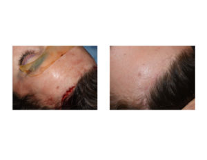 incision-and-scar-healing-of-endoscopic-brow-bone-implant-placement-dr-barry-eppley-indianapolis