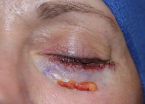 lower-blepharoplasty-injected-fat-extraction-dr-barry-eppley-indianapolis