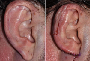 Macrotia Reduction intraop right ear Dr Barry Eppley Indianapolis