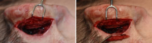 medpor-ear-framework-reduction-dr-barry-eppley-indianapolis