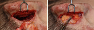medpor-ear-reconstruction-fat-grafrt-dr-barry-eppley-indianapolis