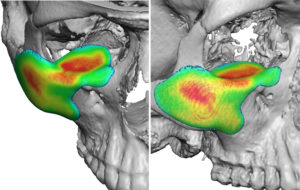 orbitozygomatic-implant-design-for-facial-asymmetry-dr-barry-eppley-indianapolis