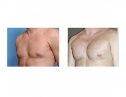 pectoral-implant-augmentation-dr-barry-eppley-indianapolis