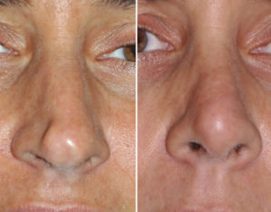Pinicchio Nose Rhinoplasty result front view Dr Barry Eppley Indianapolis
