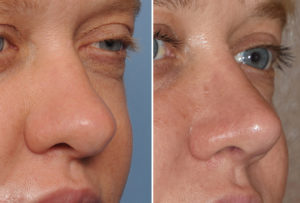 thick-nose-revision-rhinoplasty-result-oblique-view-dr-barry-eppley-indianapolis