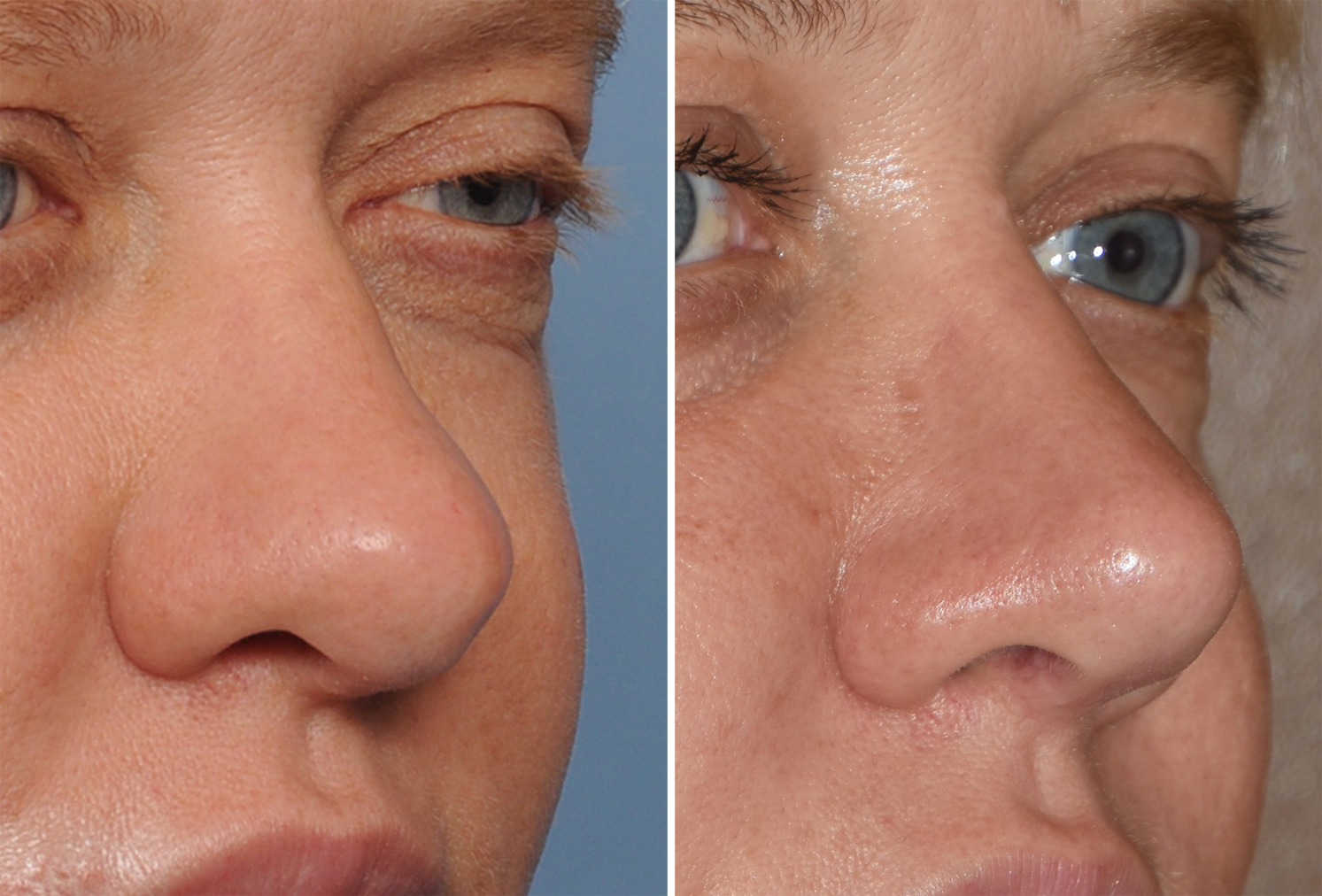 the-secret-to-nose-reshaping-without-surgery-non-surgical-rhinoplasty