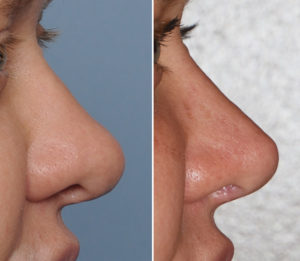 thick-nose-revision-rhinoplasty-result-side-view-dr-barry-eppley-indianapolis