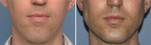 Total Jawline Augmentation result front view Dr Barry Eppley Indianapolis