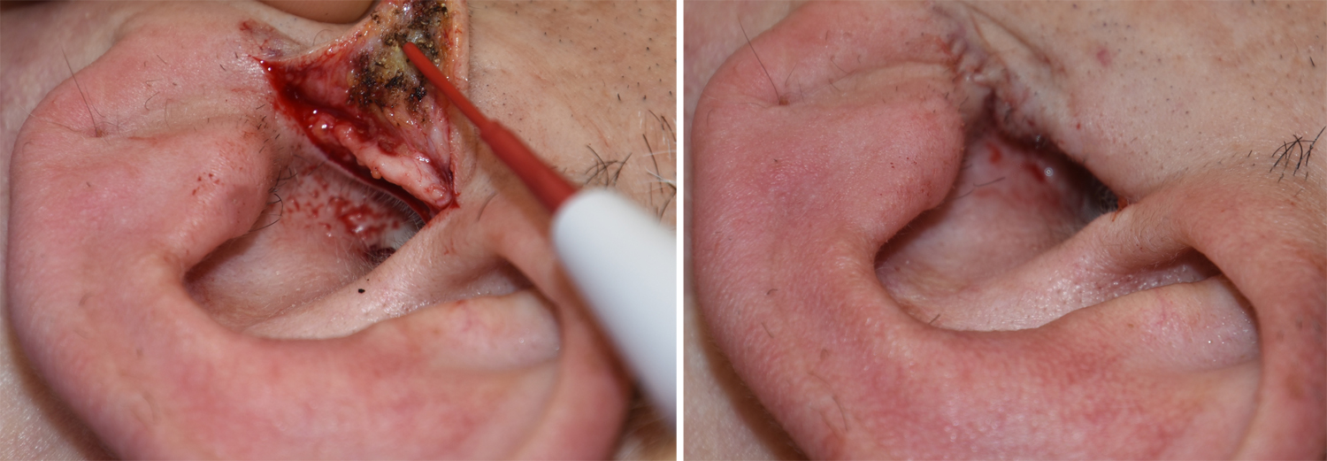 Removal of Male Tragus Hair by Flap Elevation and Follicular Cauterization  - Explore Plastic Surgery