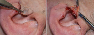 tragal-ear-skin-flap-for-hair-removal-dr-barry-eppley-indianapolis