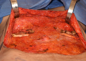 tummy-tuck-rib-removal-dr-barry-eppley-indianapolis