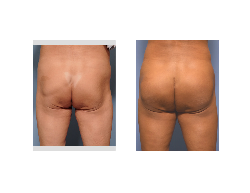 Butt augmentation with implants - Plastic Surgeon