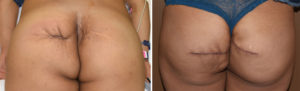 buttock-reconstruction-with-dermal-fat-grafts-result-bvack-view-dr-barry-eppley-indianapolis