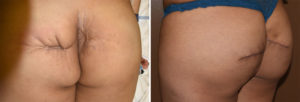 buttock-reconstruction-with-dermal-fat-grafts-result-left-side-view-dr-barry-eppley-indianapolis