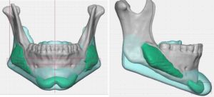 custom-jawline-implant-replacement-design-dr-barry-eppley-indianapolis