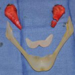 custom-jawline-implant-replacement-surgery