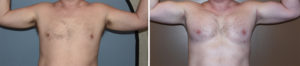 custom-pectoral-and-bicep-implants-result-front-view-dr-barry-eppley-indianapolois