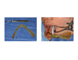 female-custom-jawline-implant-intraoperative-insertion-dr-barry-eppley-indianapolis