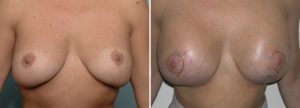 late-breast-lift-scar-result-dr-barry-eppley-indianapolis