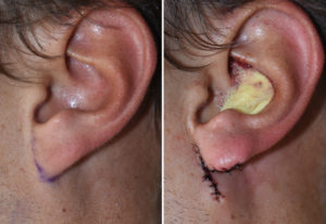 left-earlobe-attachment-surgery-result-dr-barry-eppley-indianapolis