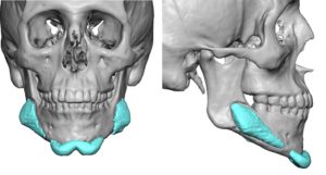 malpositioned-chin-and-jaw-angle-implants