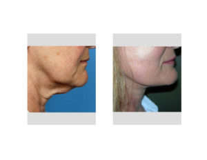 necklift-dr-barry-eppley-indianapolis