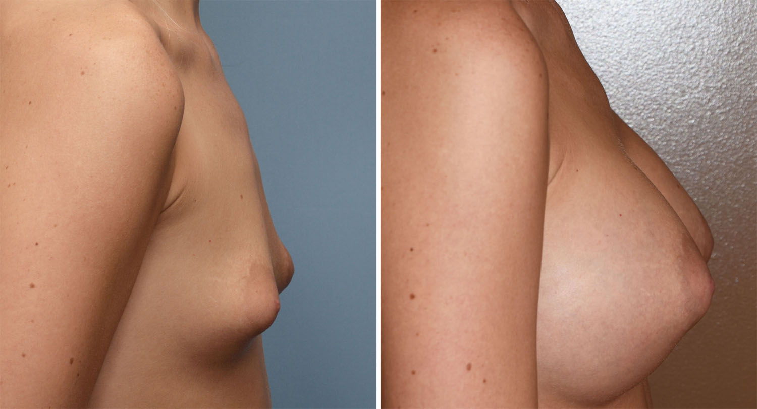  Blog Archivecase Study - Puffy Nipple Breast Augmentation-1003