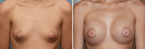 puffy-nipple-breast-augmentation-results-front-view-dr-barry-eppley-indianapolis