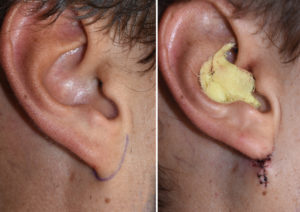 right-earlobe-attachment-surgery-result-dr-barry-eppley-indianapolis