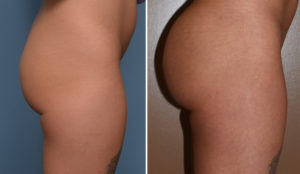 tb-buttock-implants-side-view-dr-barry-eppley-indianapolis