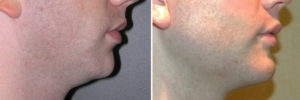 three-piece-chin-and-jaw-angle-implants-result-side-vuew-dr-barry-eppley-indianapolis
