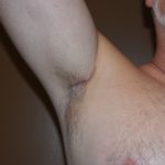 transaxillary-incision-for-pectoral-and-bicep-implants-dr-barry-eppley-indianapolis