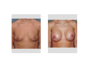 breast-implants-and-stretch-marks-result-front-view-dr-barry-eppley-indianapolis