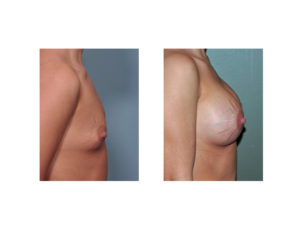 breast-implants-and-stretch-marks-result-side-view-dr-barry-eppley-indianapolis